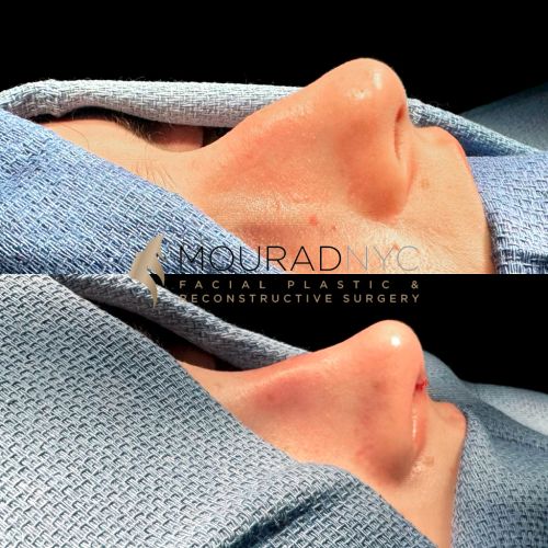 Before and After Rhinoplasty