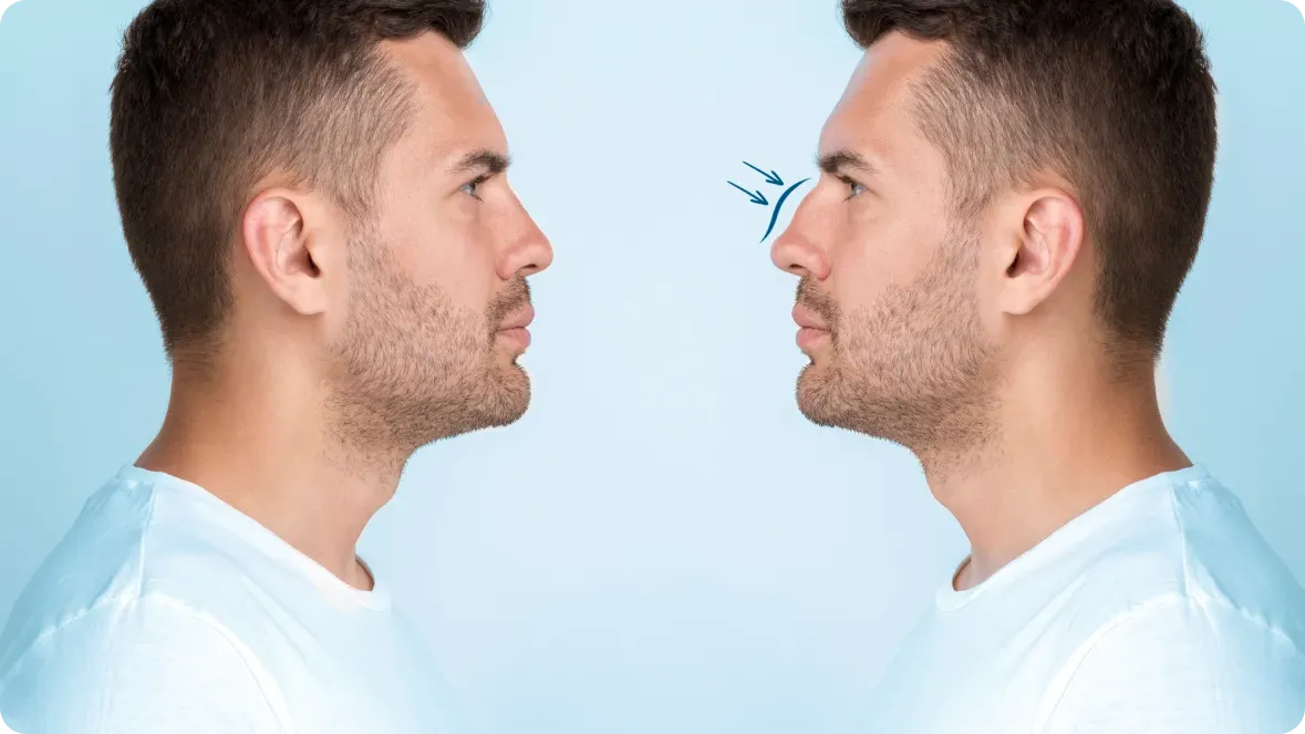 Rhinoplasty surgery