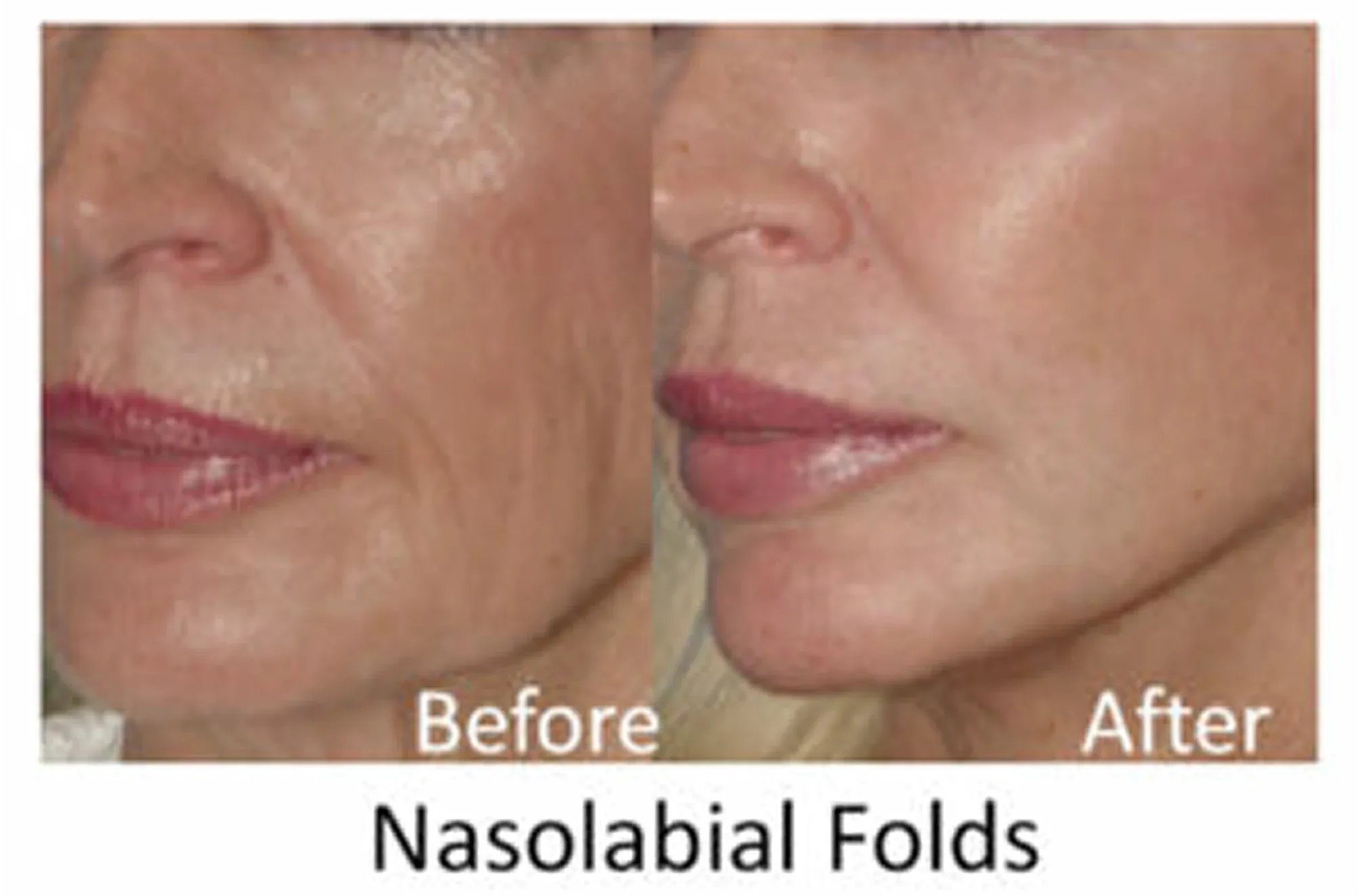 Nasolabial Folds