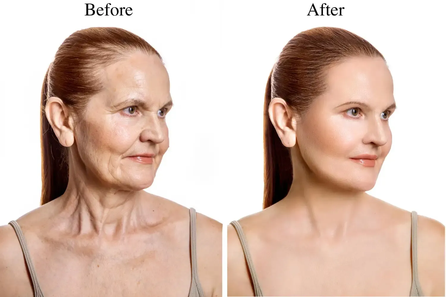 Facelift Results before- after