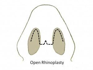 Open-Rhinoplasty