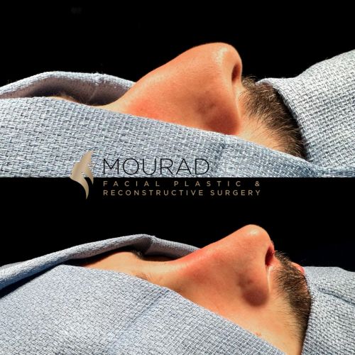 Before and after Male Rhinoplasty/Septoplasty