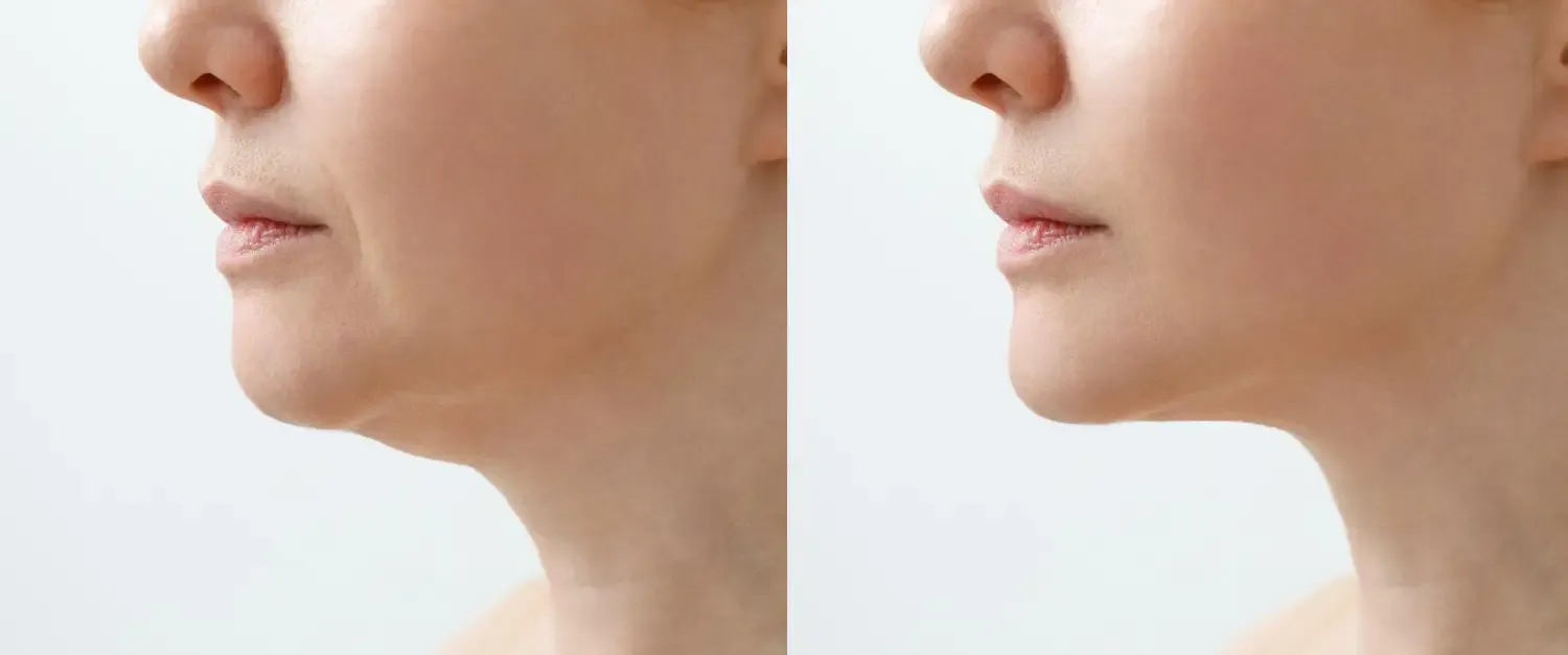 Before-and-After Facelift Results