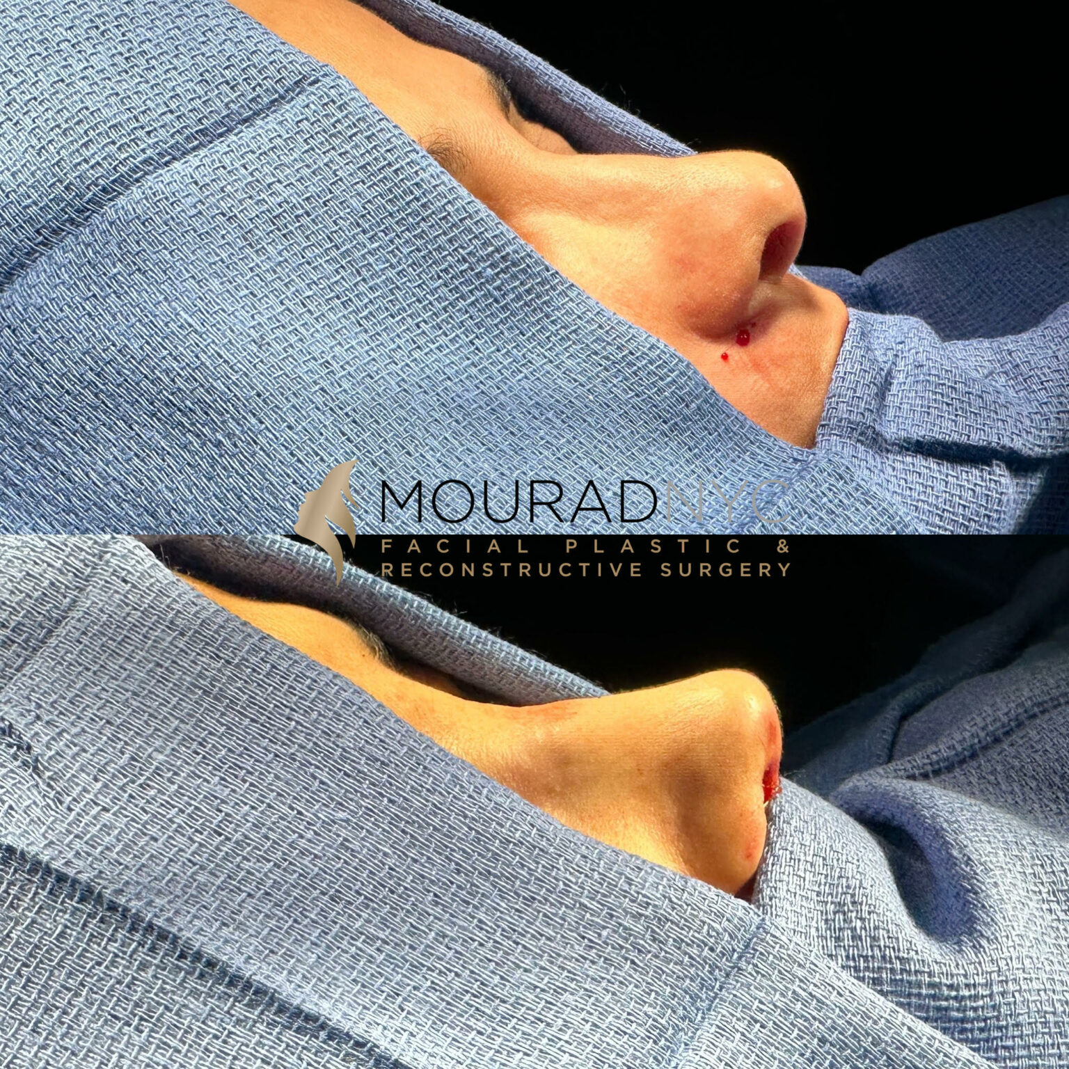 Nasal Valve Collapse Mourad MD Facial Plastic Surgeon Symptoms