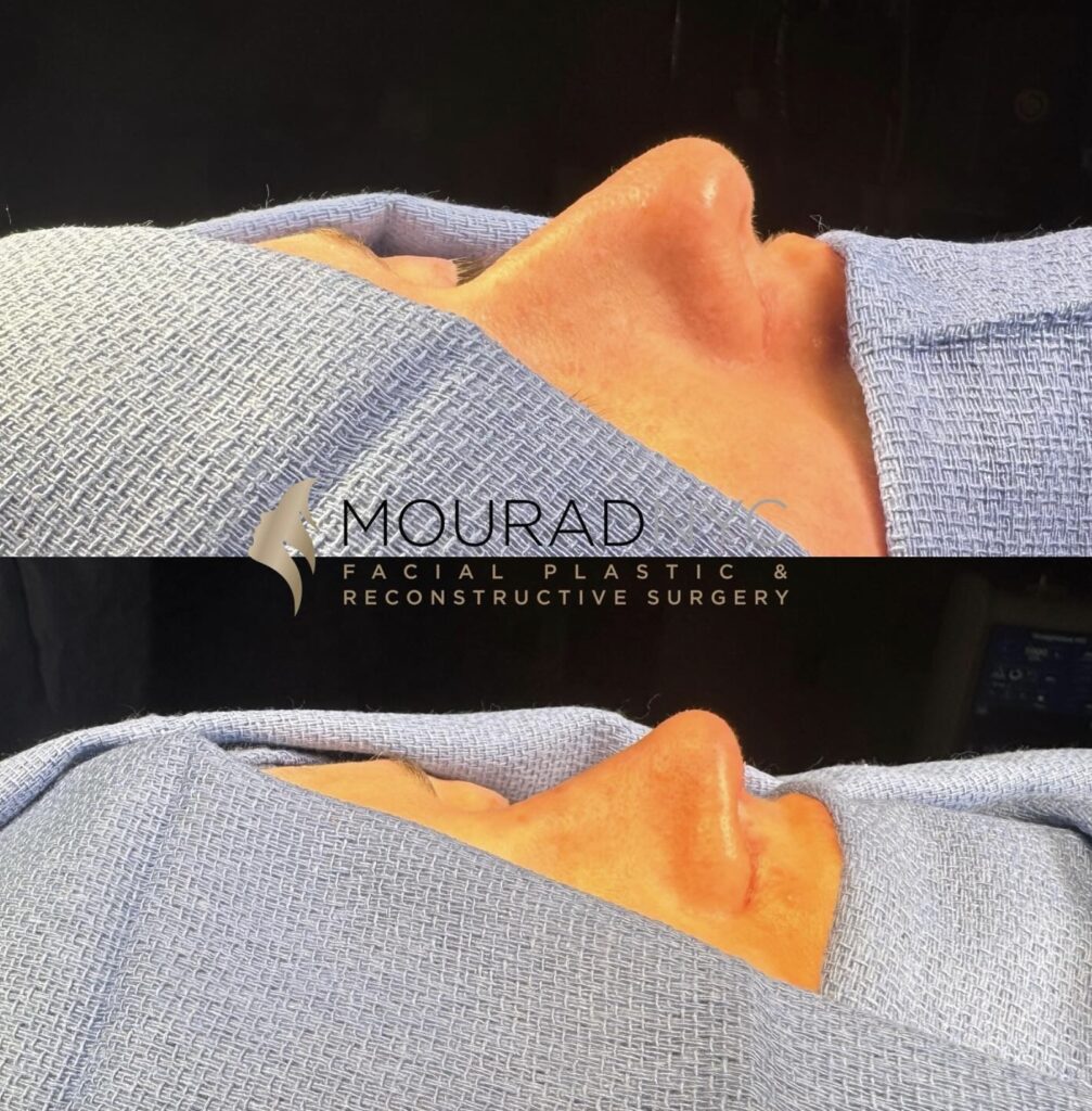 Before and After Female Rhinoplasty