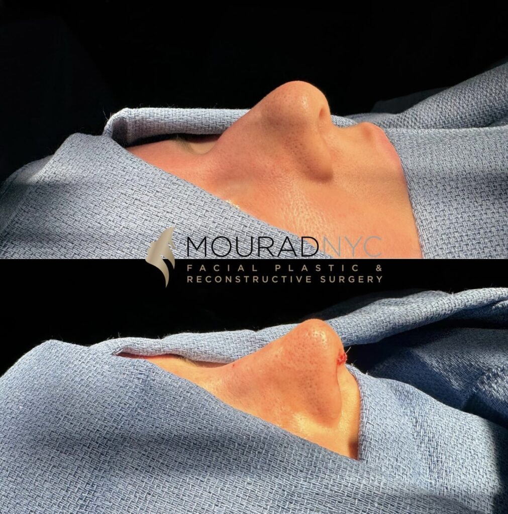 Before and After Female Rhinoplasty