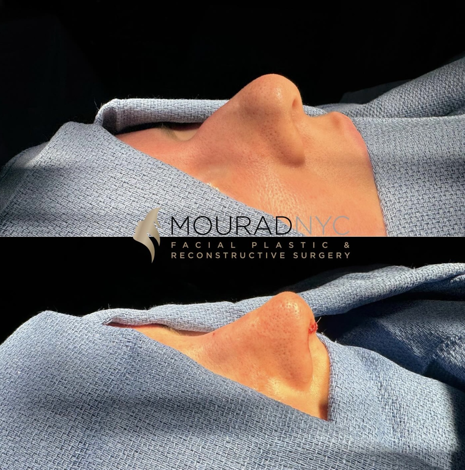 Before and After Female Rhinoplasty