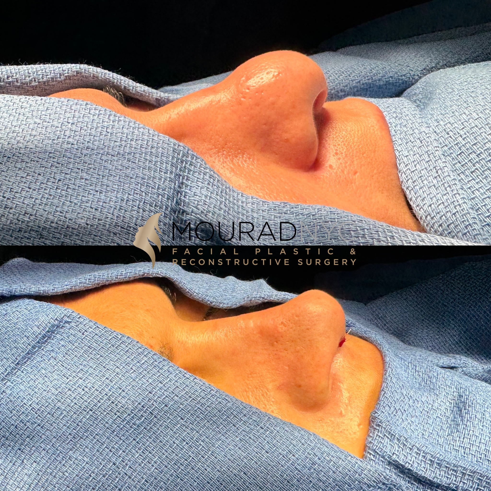 Before and After Male Rhinoplasty