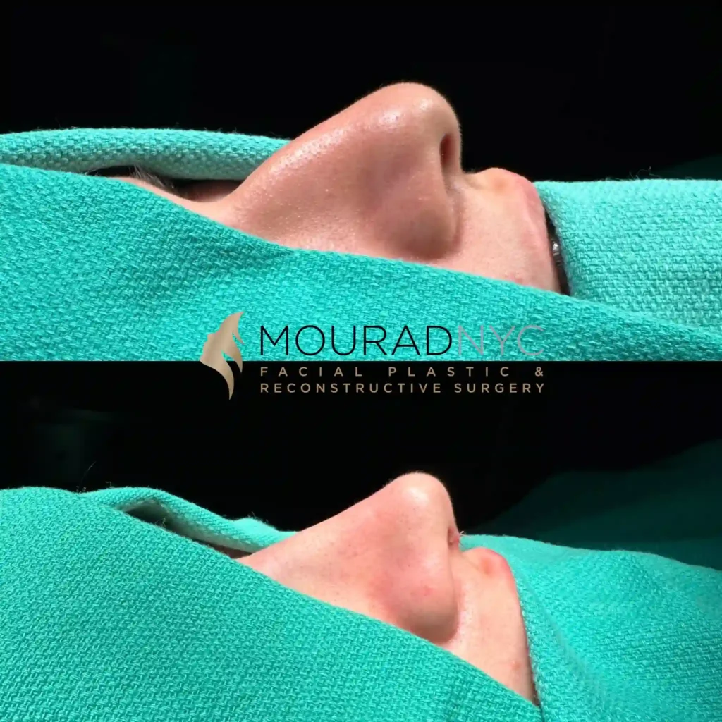 Before and After Female 20s Primary Rhinoplasty