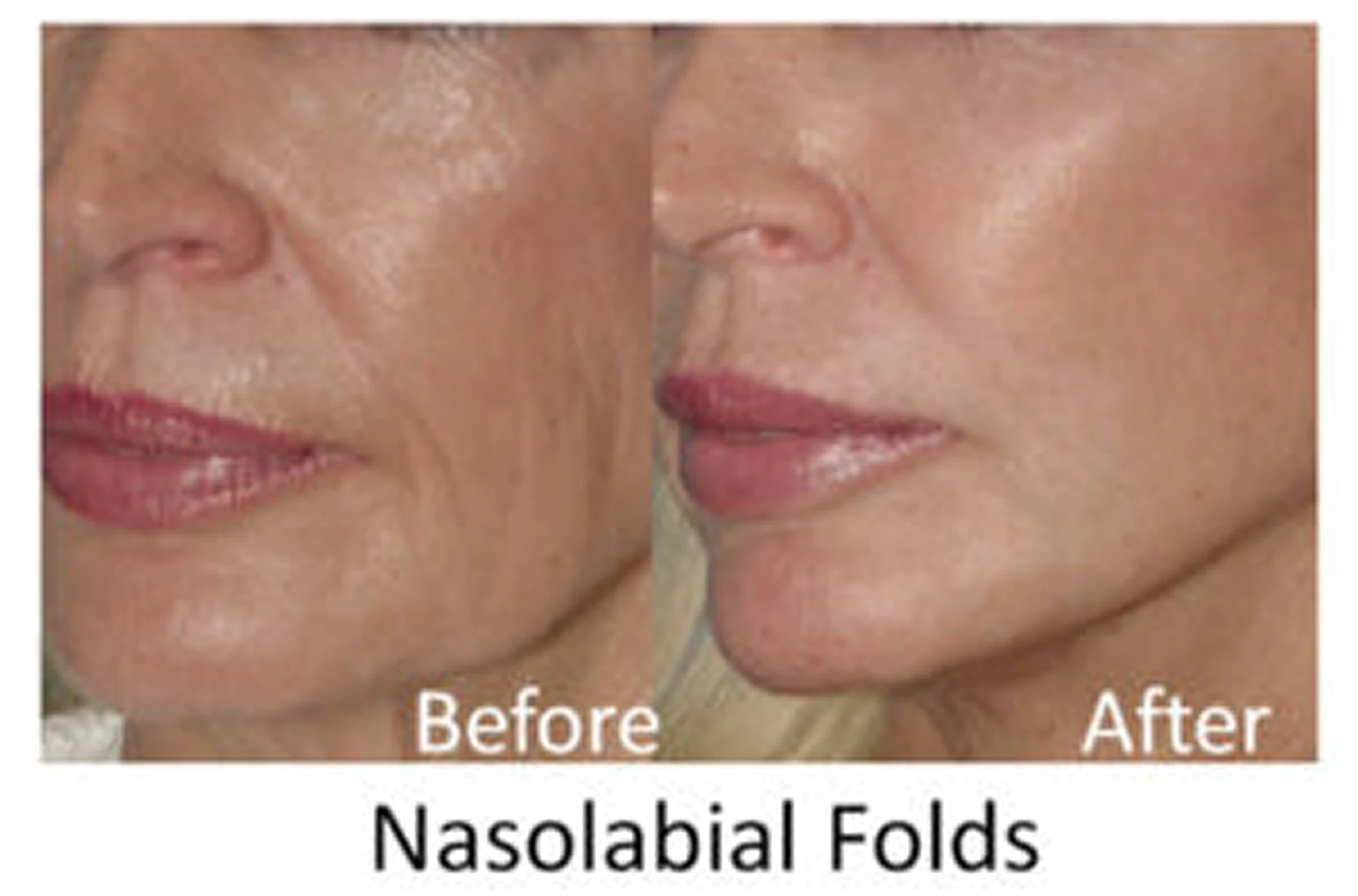 Nasolabial Folds