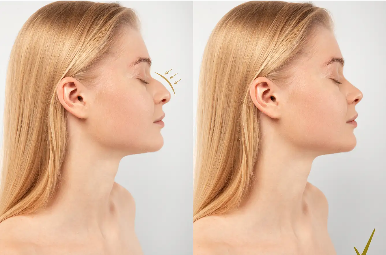 What is Rhinoplasty