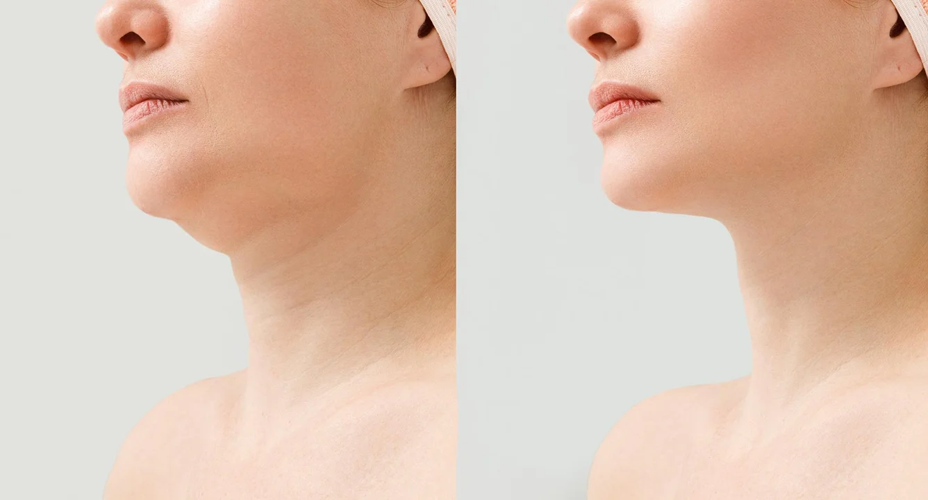 What is a Neck Lift