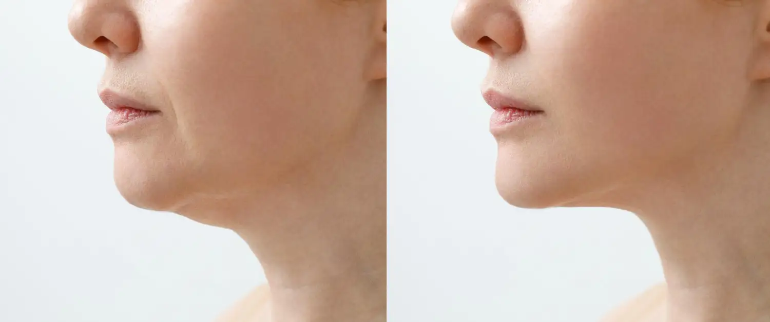 Before-and-After Facelift Results