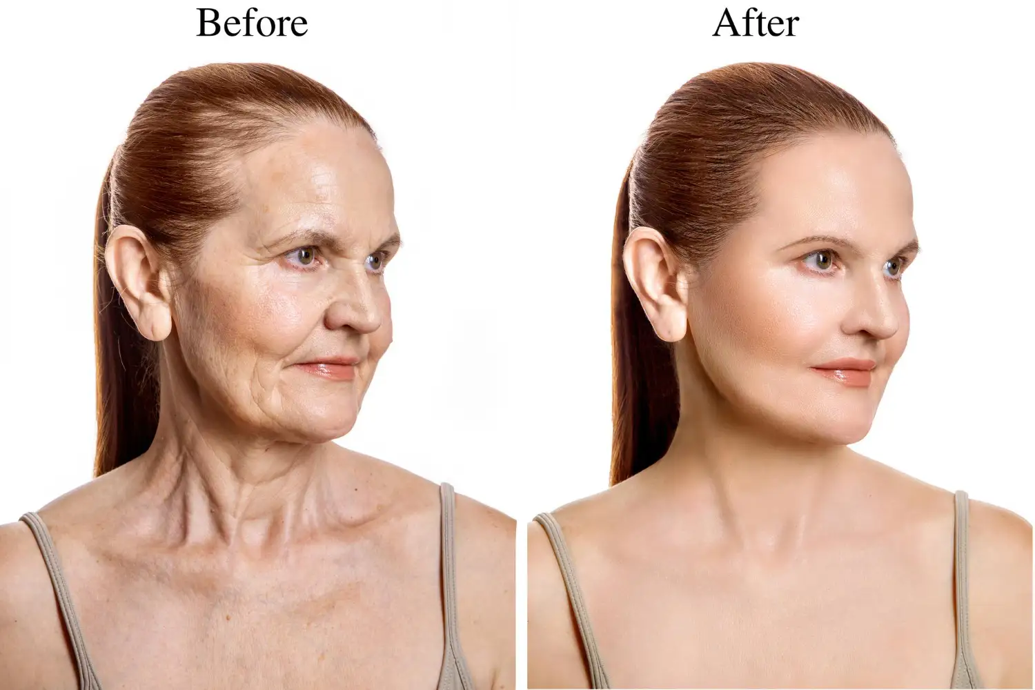 Facelift Results before- after
