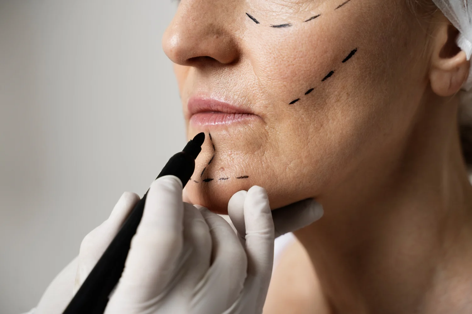 Choose the Right Facelift Surgeon