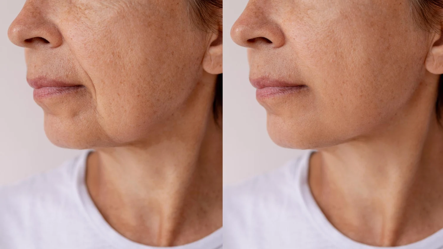 Common Myths About Facelifts