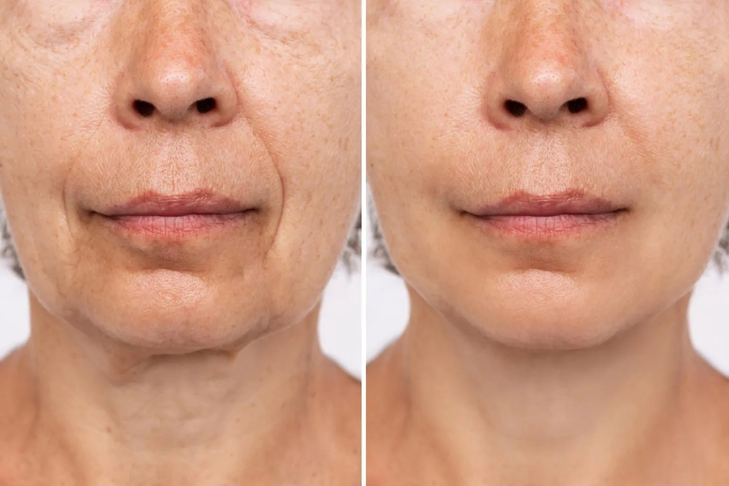 Emerging Trends in Facelift