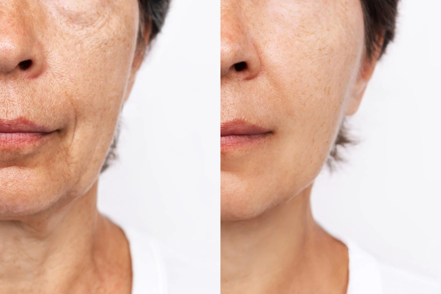 Fat Grafting in Modern Facelift