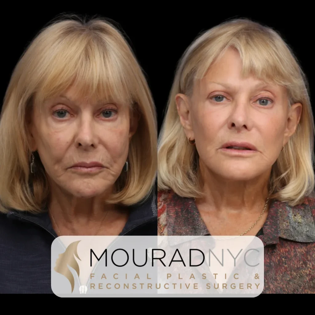 Before and After Female Deep Plane Facelift