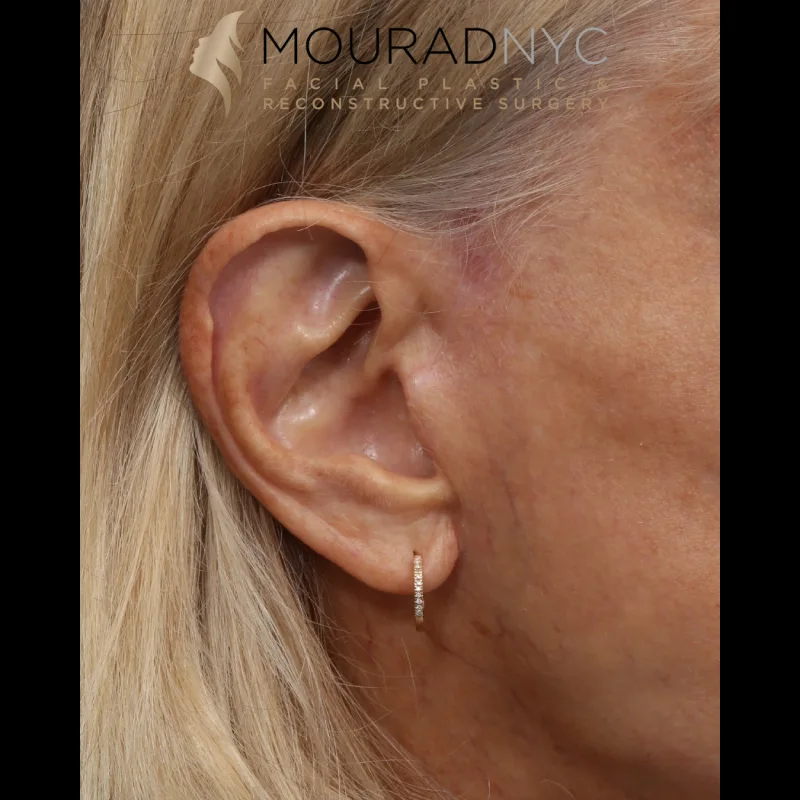 Before and After Female Deep Plane Facelift