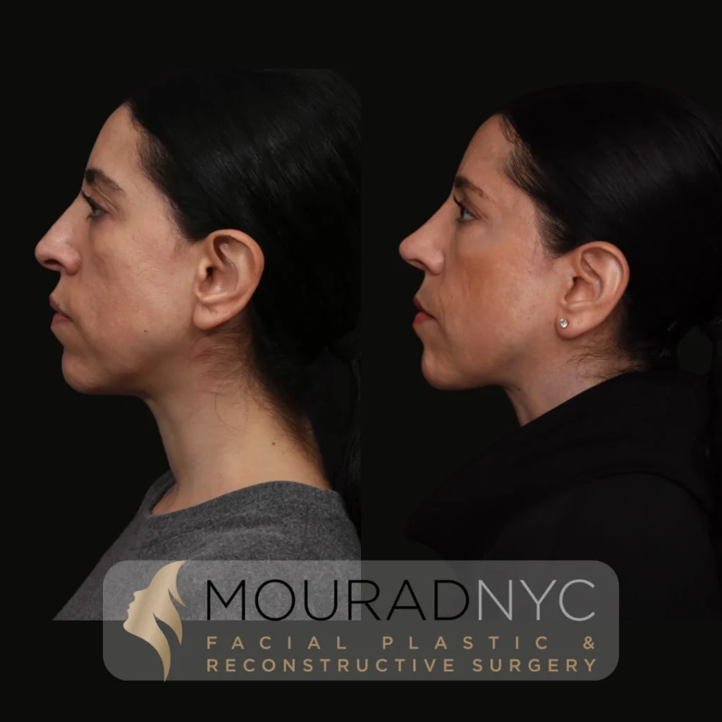 Before and After Female 30s Rhinoplasty