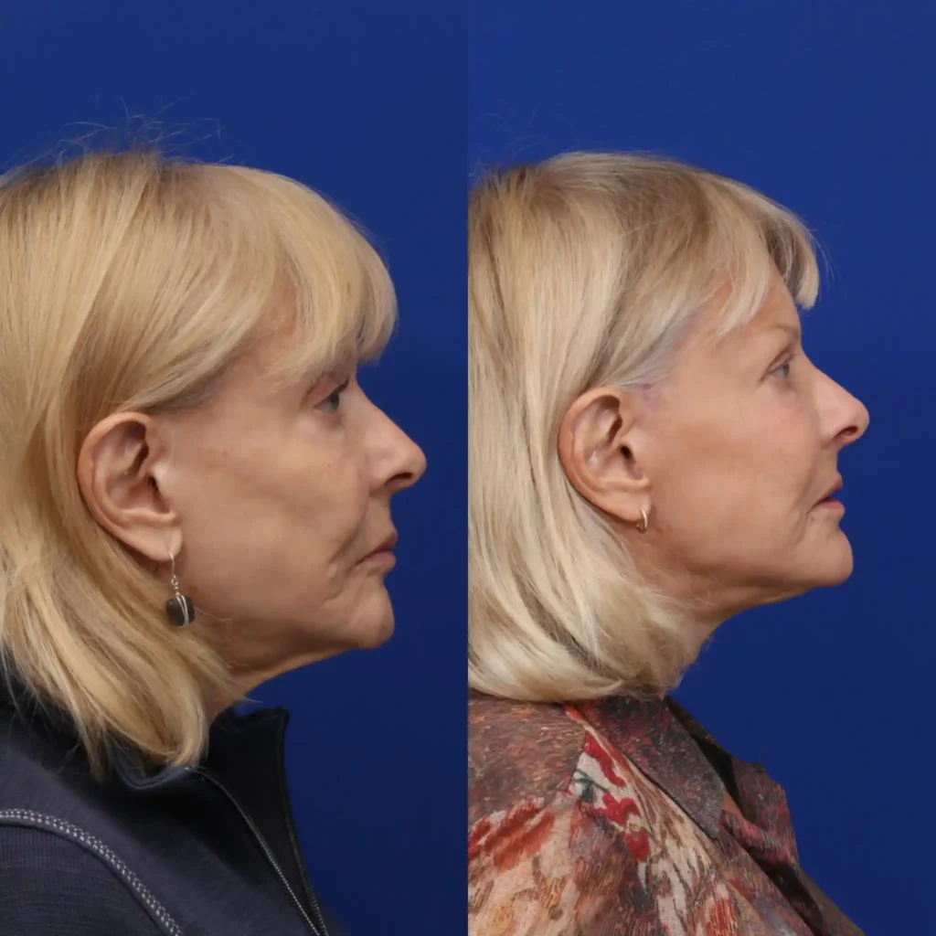 Before and After Female Deep Plane Facelift