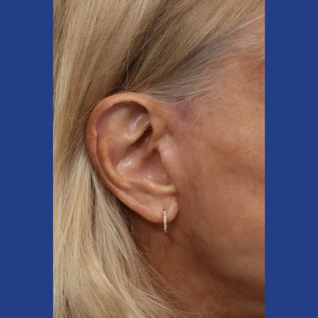 Before and After Female Deep Plane Facelift