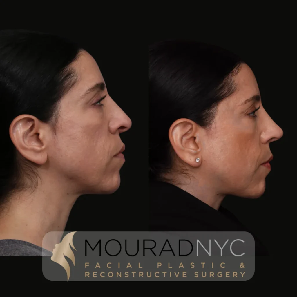 Before and After Female 30s Rhinoplasty
