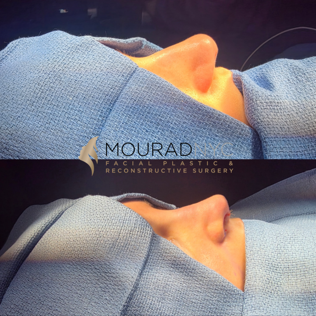 Before and After Female Rhinoplasty