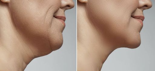 The Best Surgical and Non-Surgical Procedures For Neck Tightening
