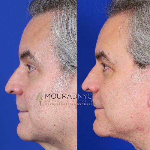 Male Facelift Before and After