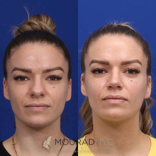 Before and after Rhinoplasty